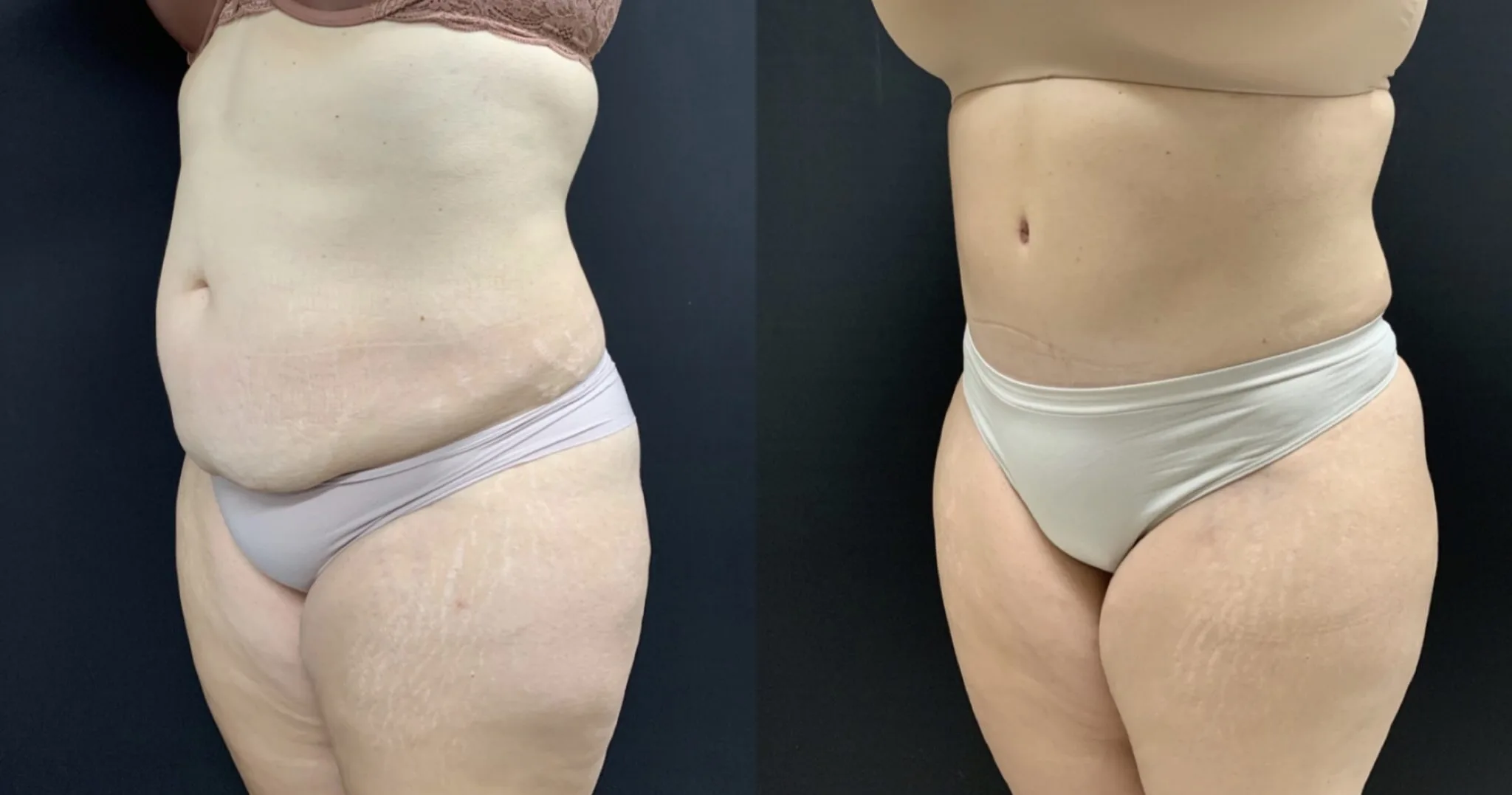 TUMMY TUCK Before & After Case Number 00052