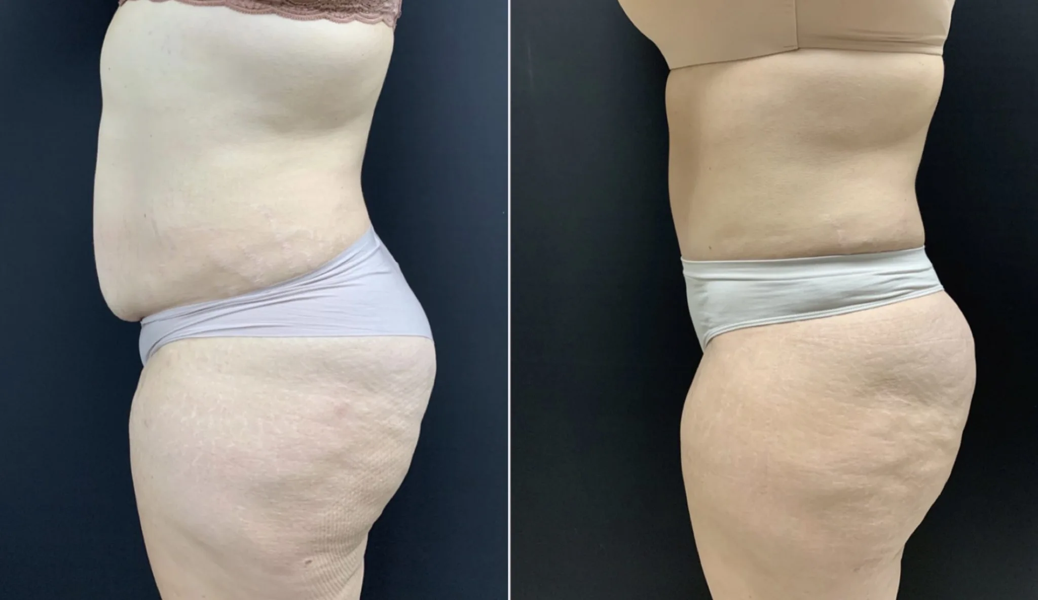 TUMMY TUCK Before & After Case Number 00052