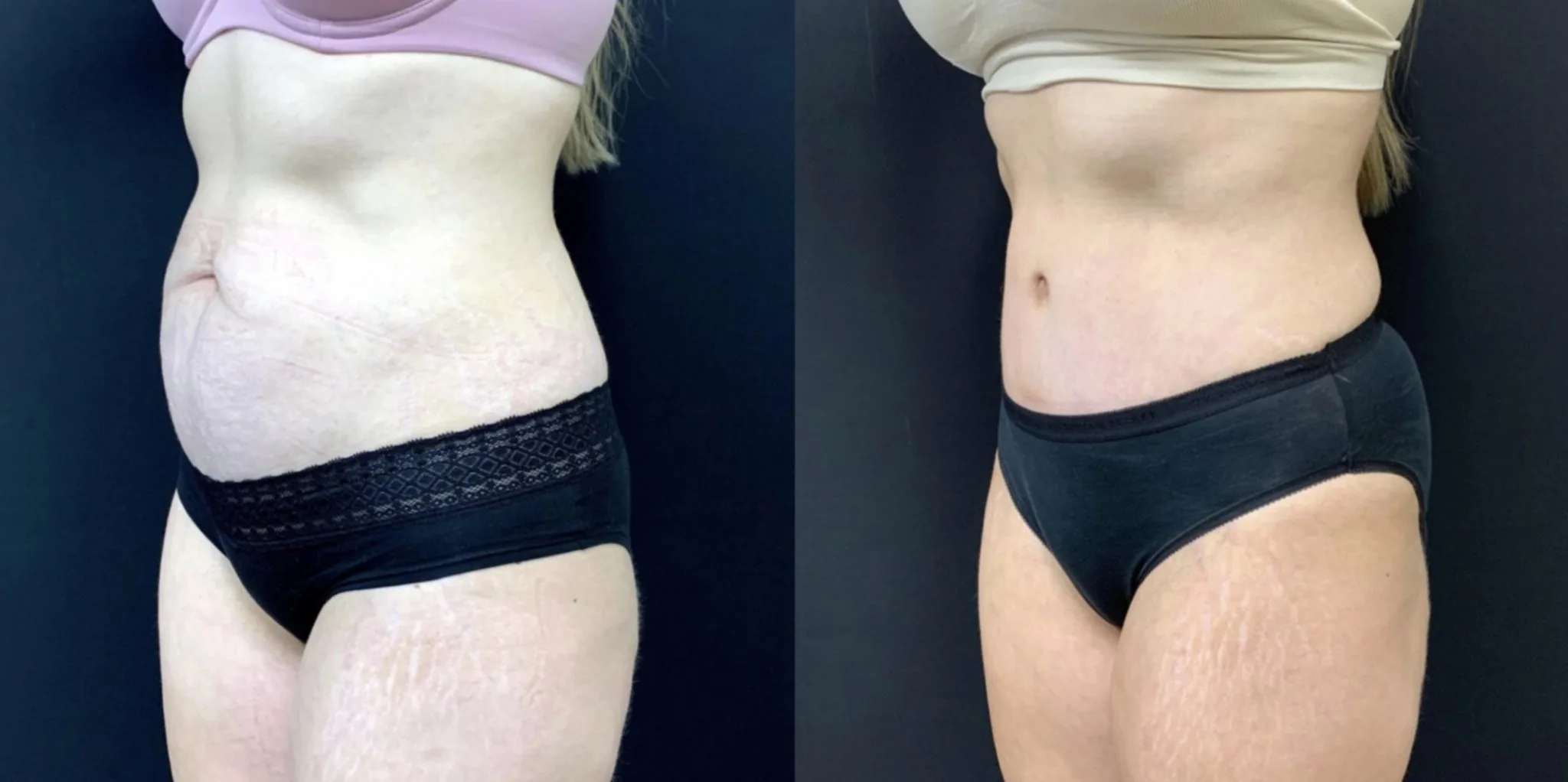 TUMMY TUCK Before & After Case Number 00054