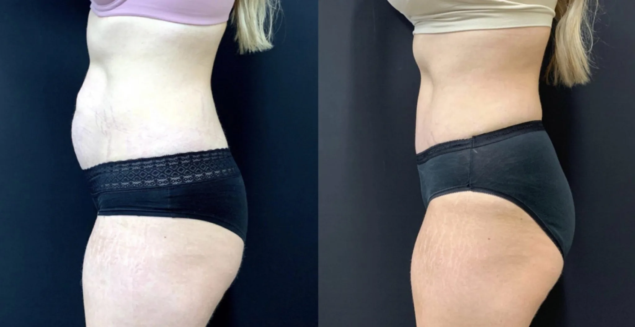 TUMMY TUCK Before & After Case Number 00054
