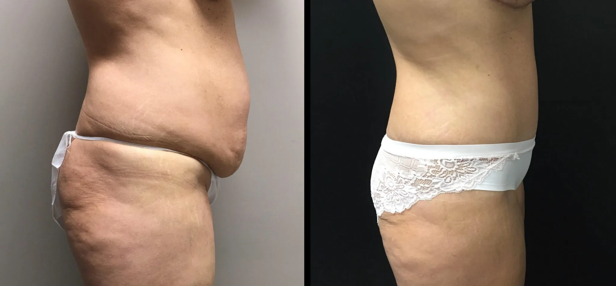 TUMMY TUCK Before & After Case Number 00056