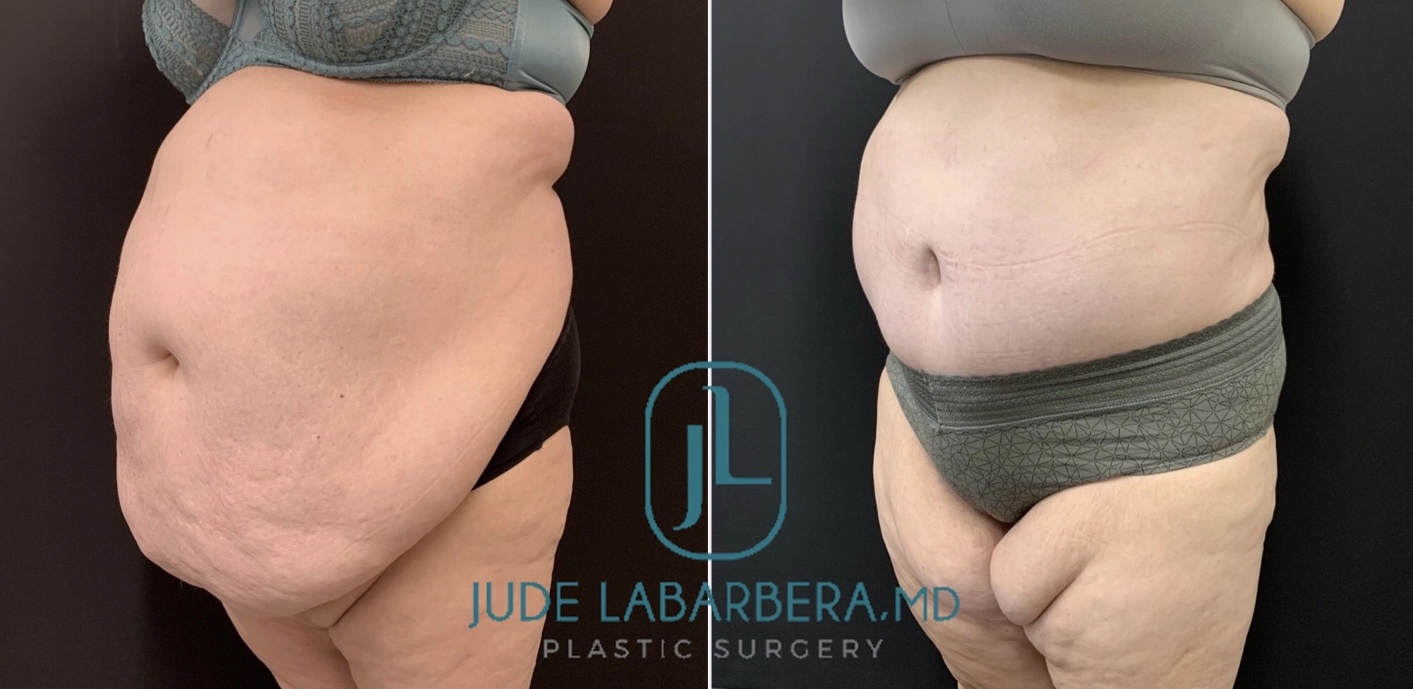 TUMMY TUCK Before & After Case Number 00061