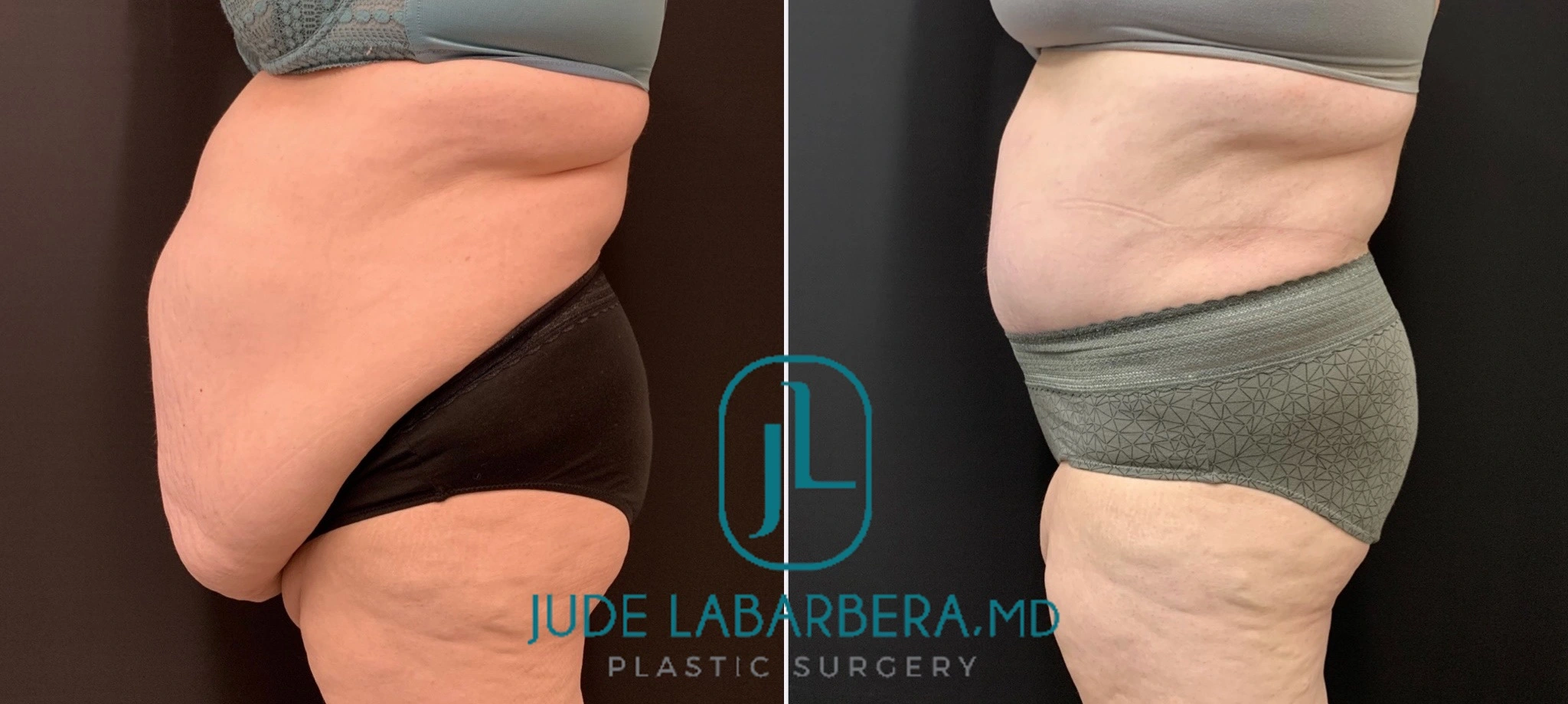 TUMMY TUCK Before & After Case Number 00061