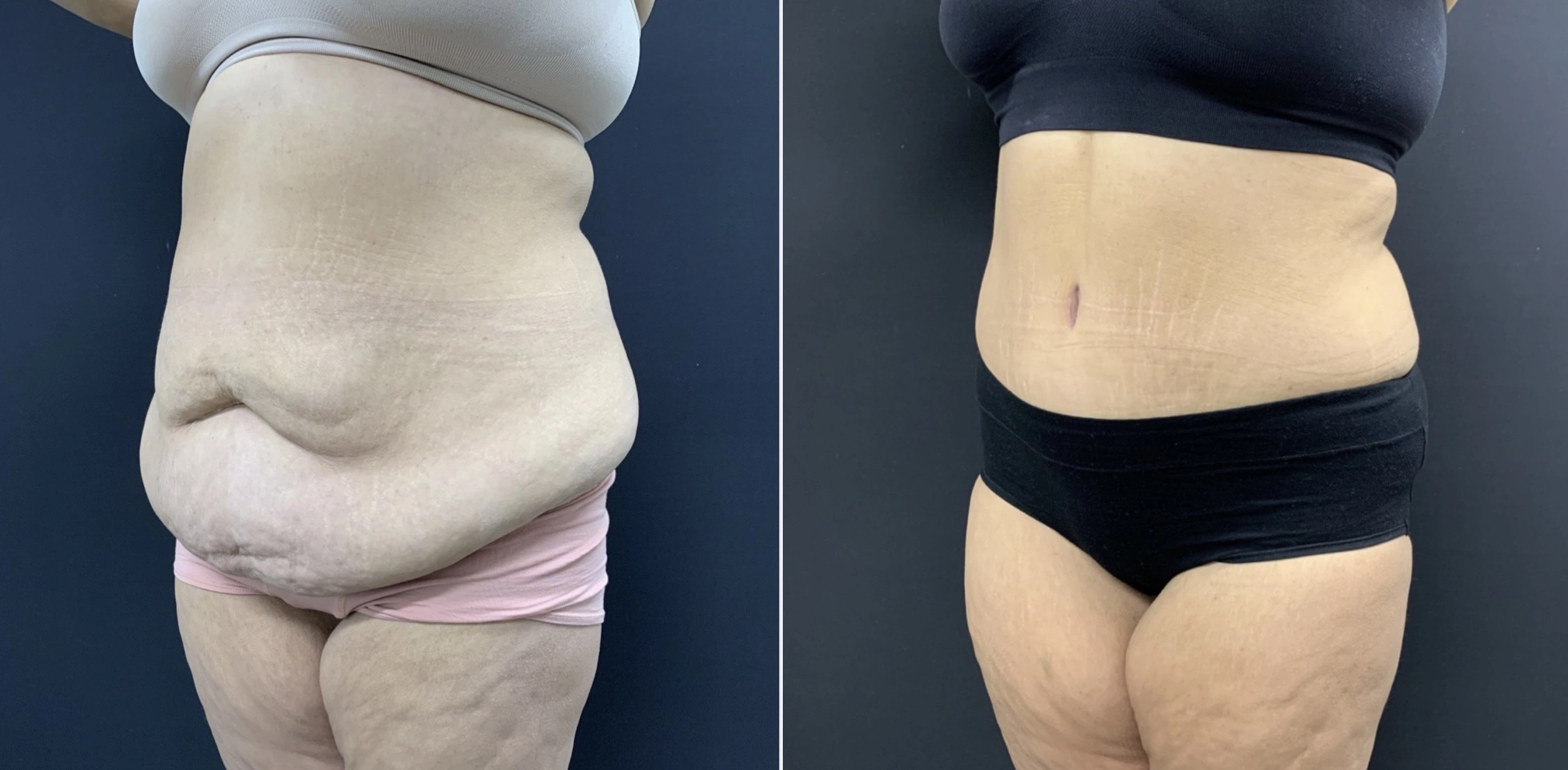 TUMMY TUCK Before & After Case Number 00062