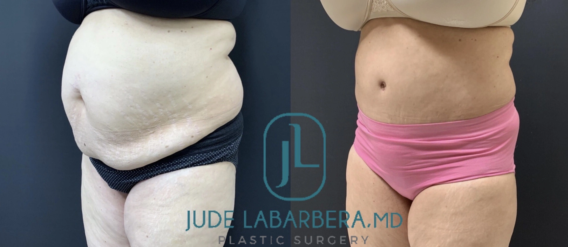 TUMMY TUCK Before & After Case Number 00069