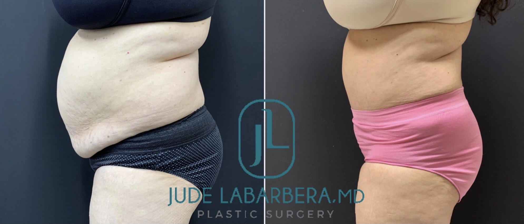 TUMMY TUCK Before & After Case Number 00069