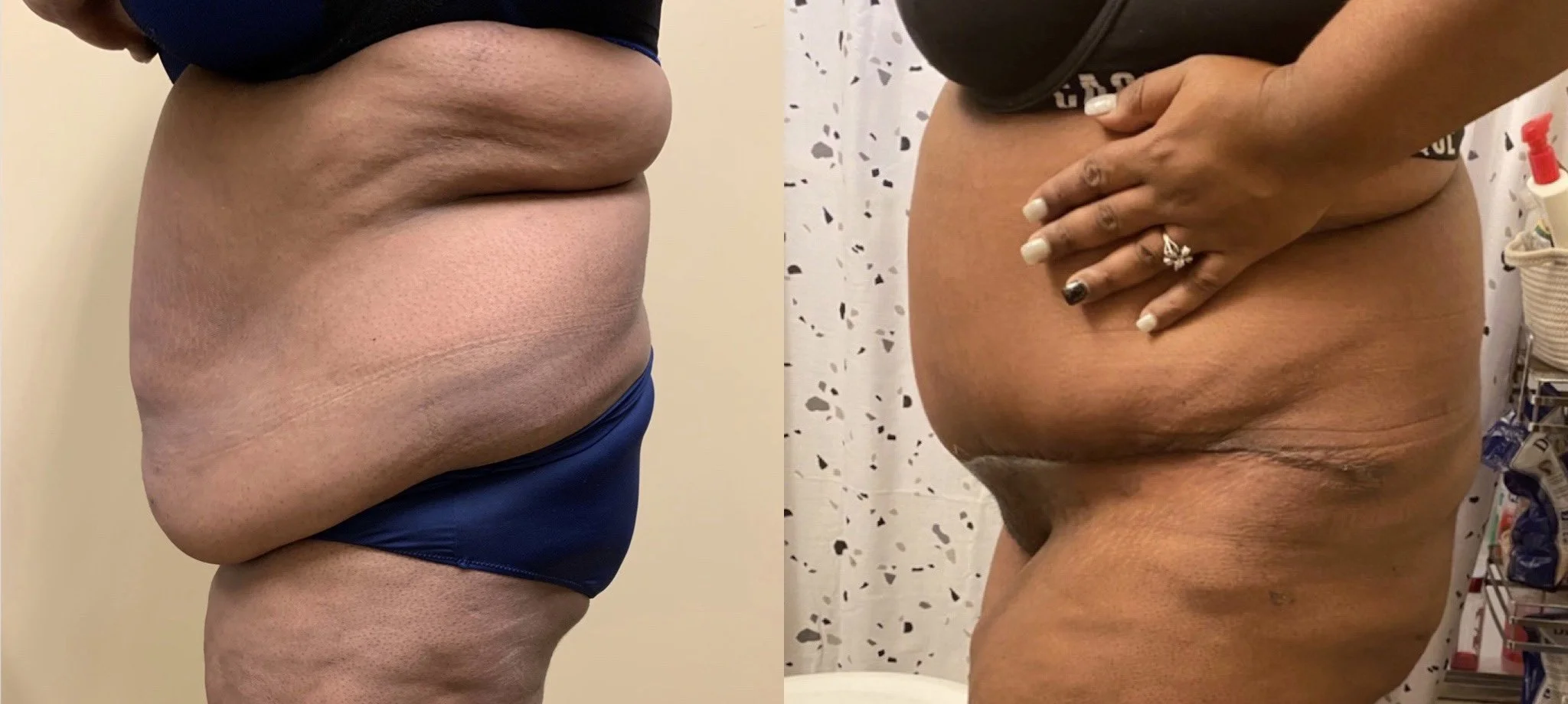Tummy Tuck Before & After Case Number 0007