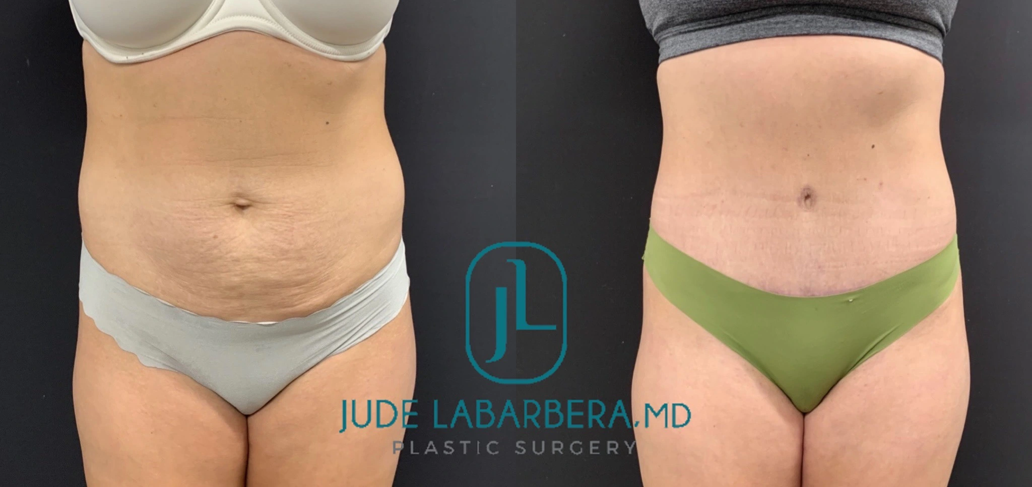 TUMMY TUCK Before & After Case Number 00073