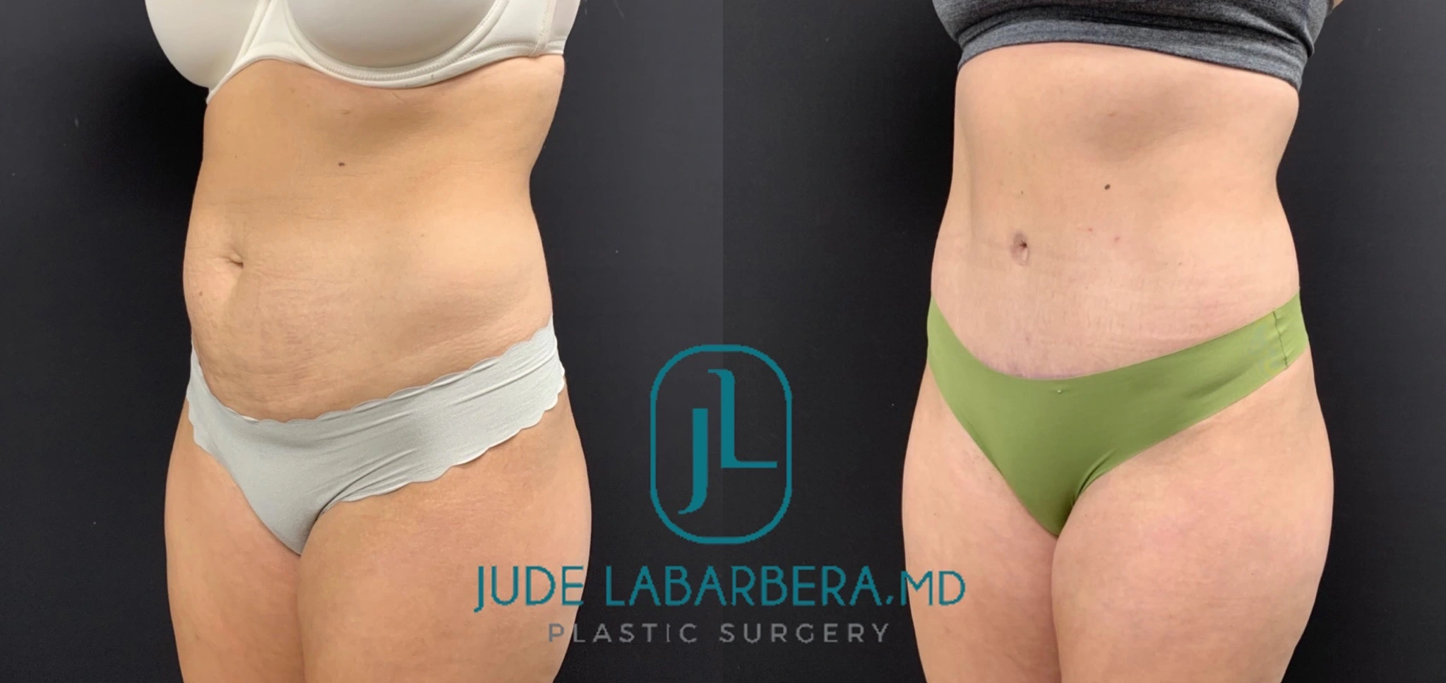 TUMMY TUCK Before & After Case Number 00073