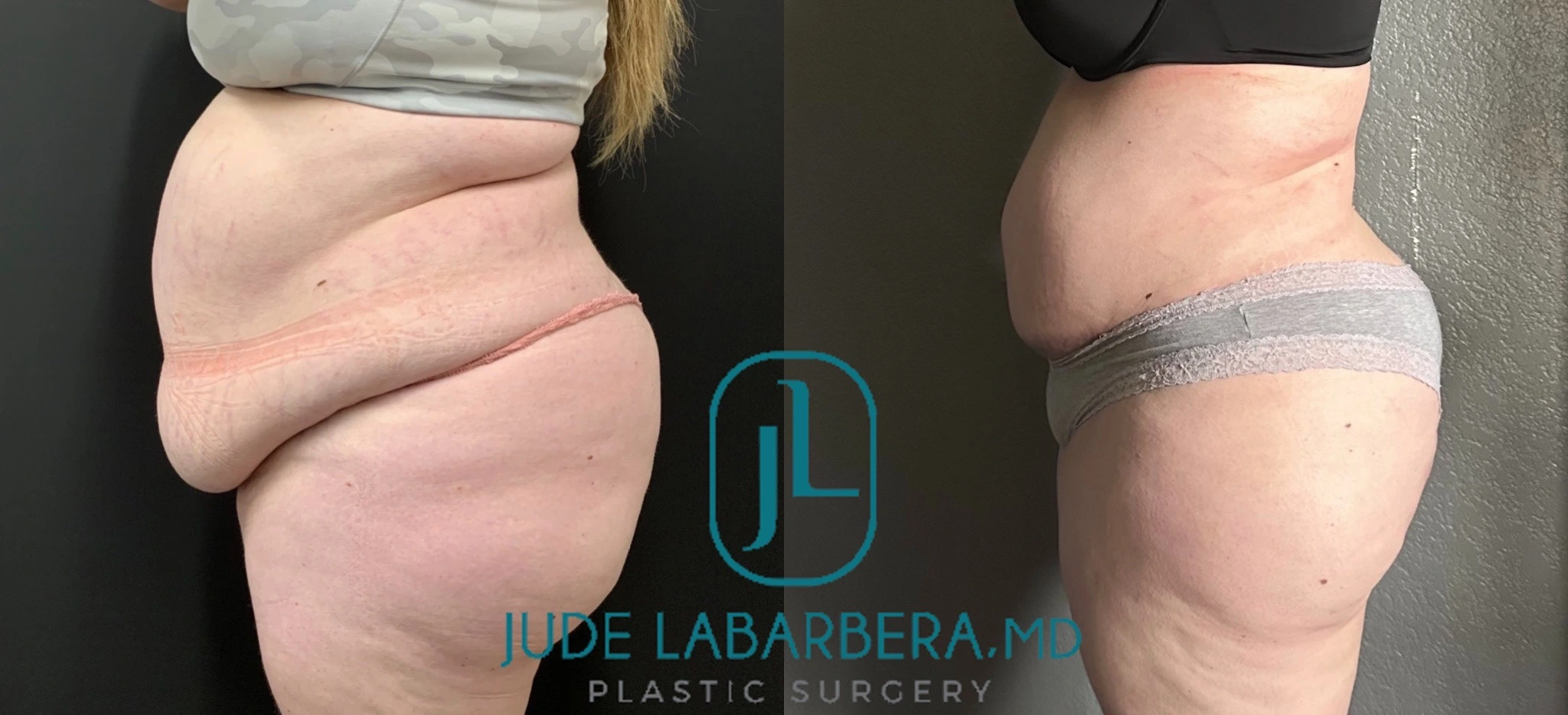 TUMMY TUCK Before & After Case Number 00075