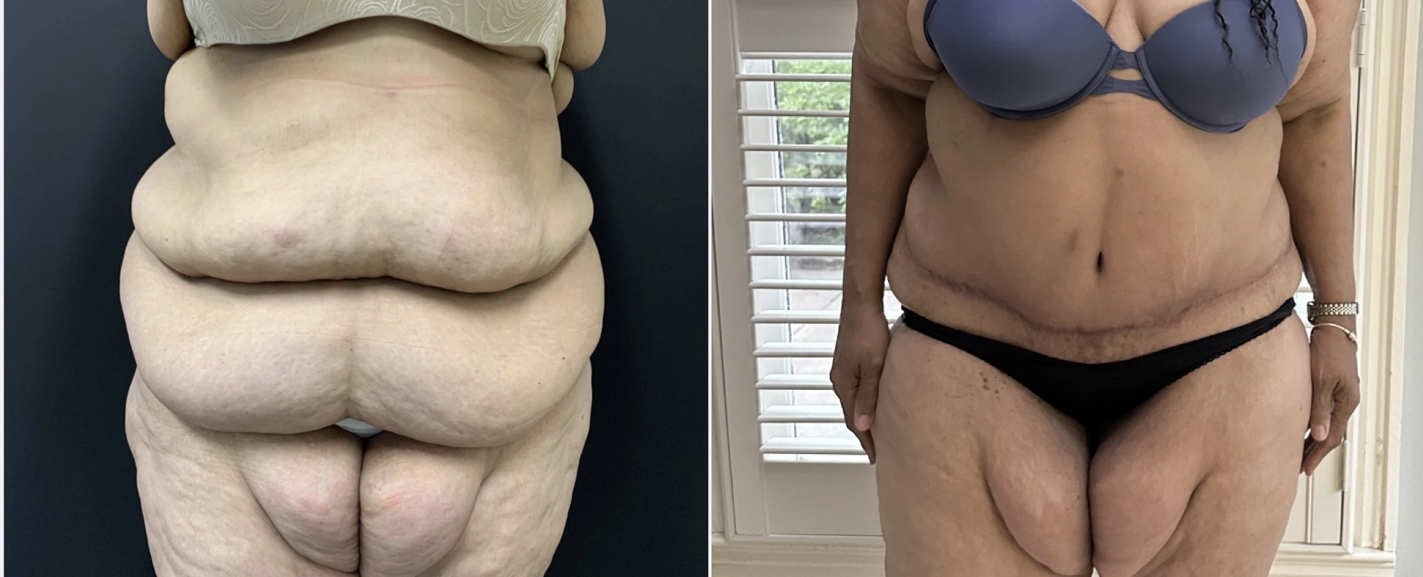 TUMMY TUCK Before & After Case Number 00077