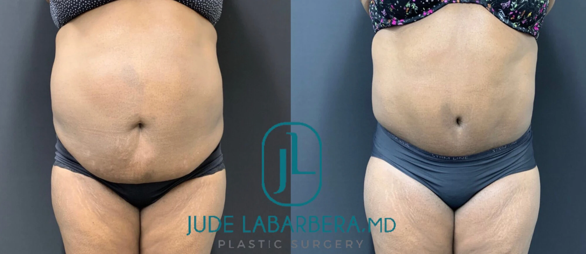 TUMMY TUCK Before & After Case Number 00081