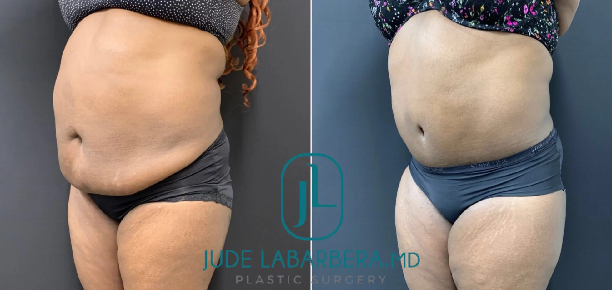 TUMMY TUCK Before & After Case Number 00081