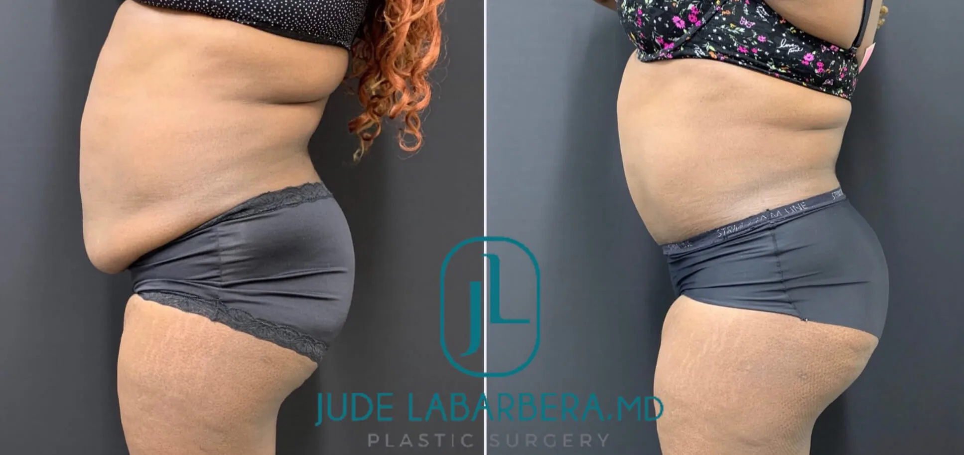 TUMMY TUCK Before & After Case Number 00081