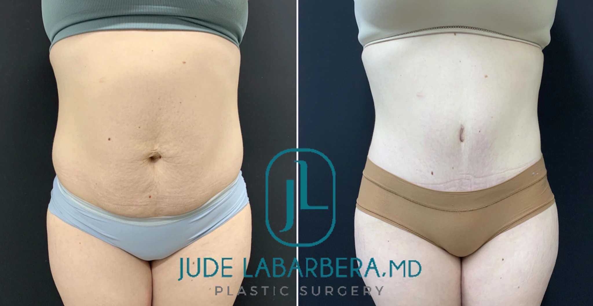 TUMMY TUCK Before & After Case Number 00083