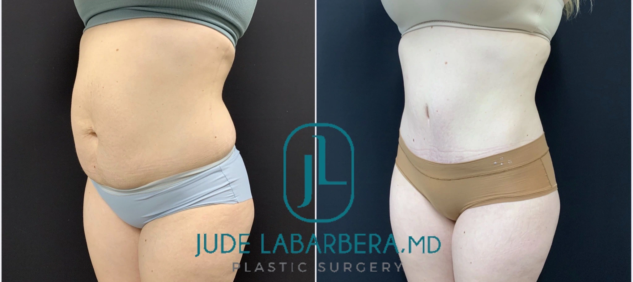 TUMMY TUCK Before & After Case Number 00083