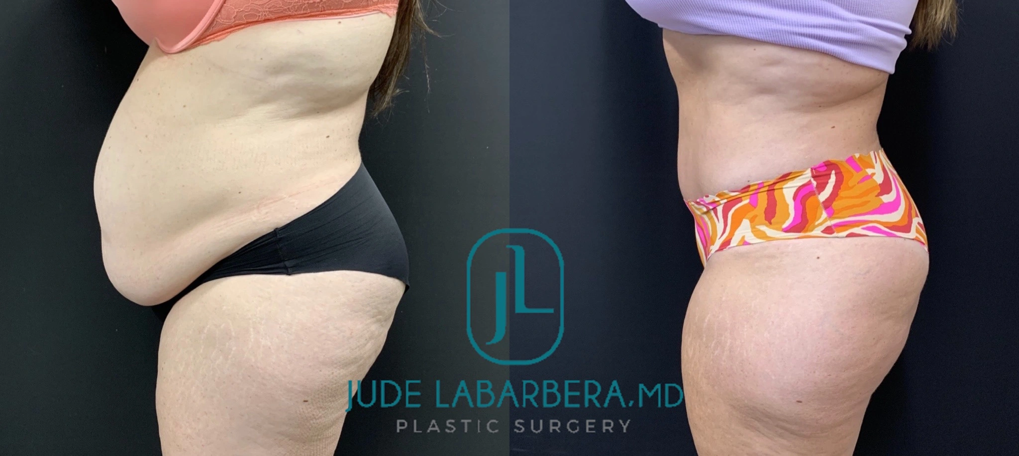 TUMMY TUCK Before & After Case Number 00084
