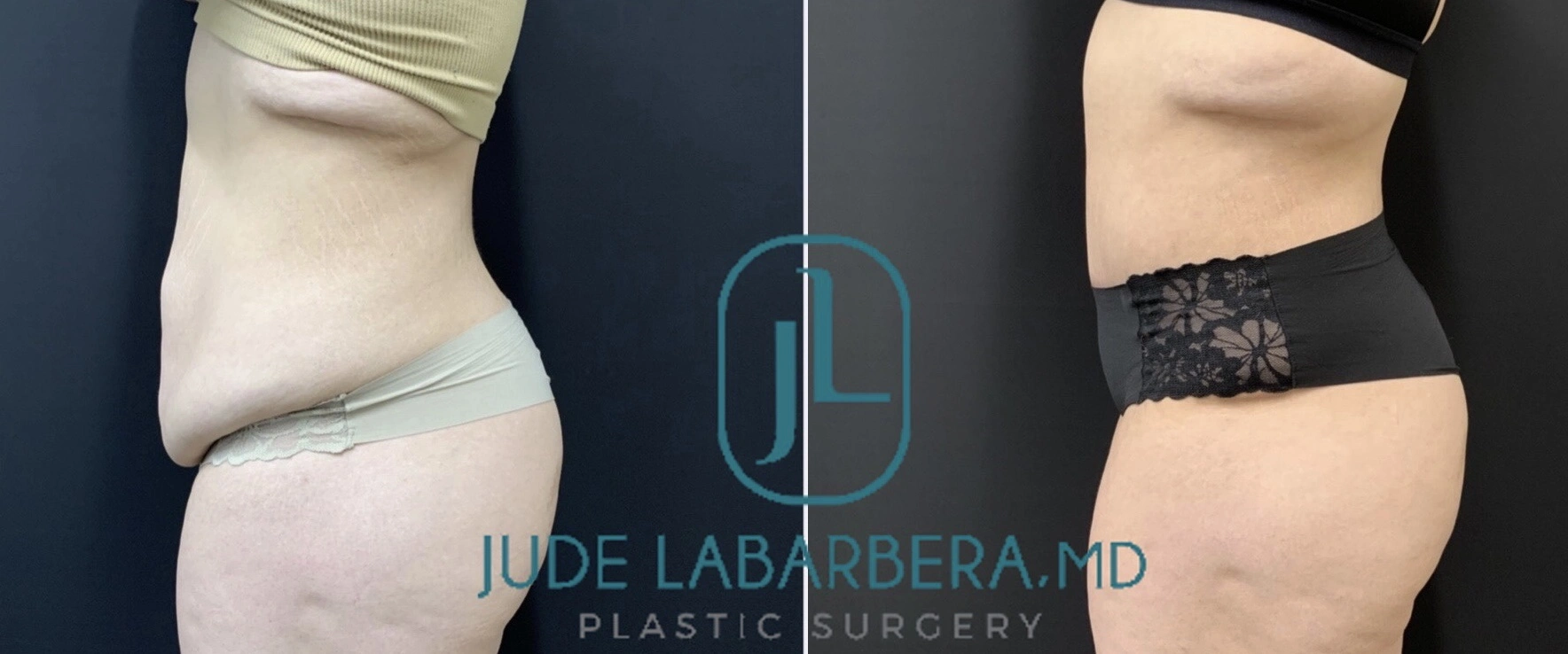 TUMMY TUCK Before & After Case Number 00085