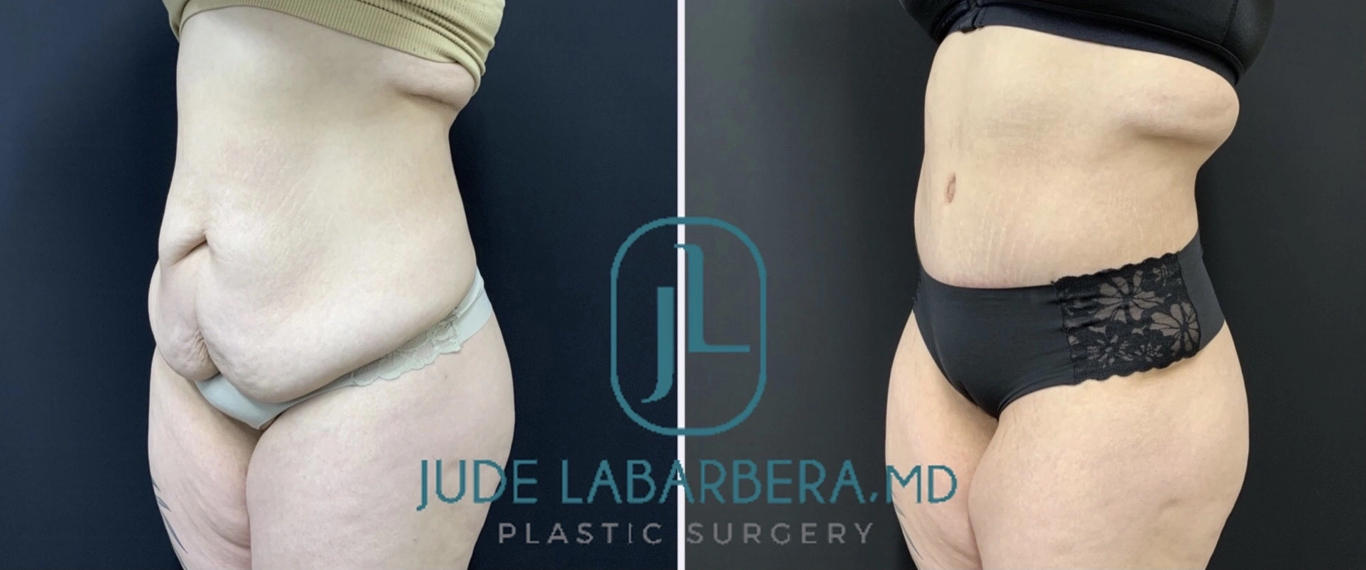 TUMMY TUCK Before & After Case Number 00085