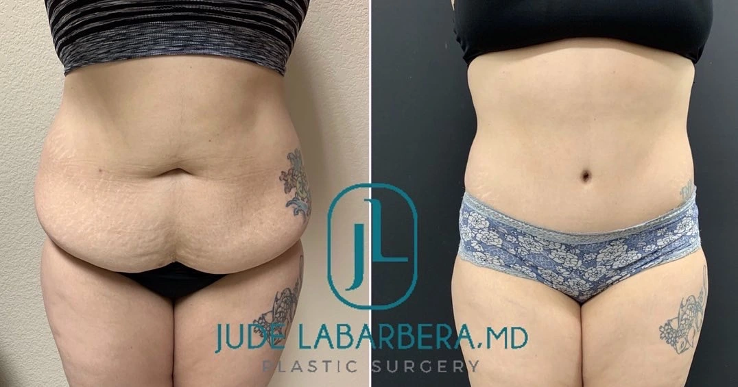 TUMMY TUCK Before & After Case Number 00087