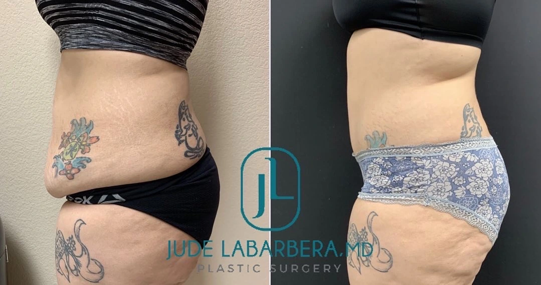TUMMY TUCK Before & After Case Number 00087