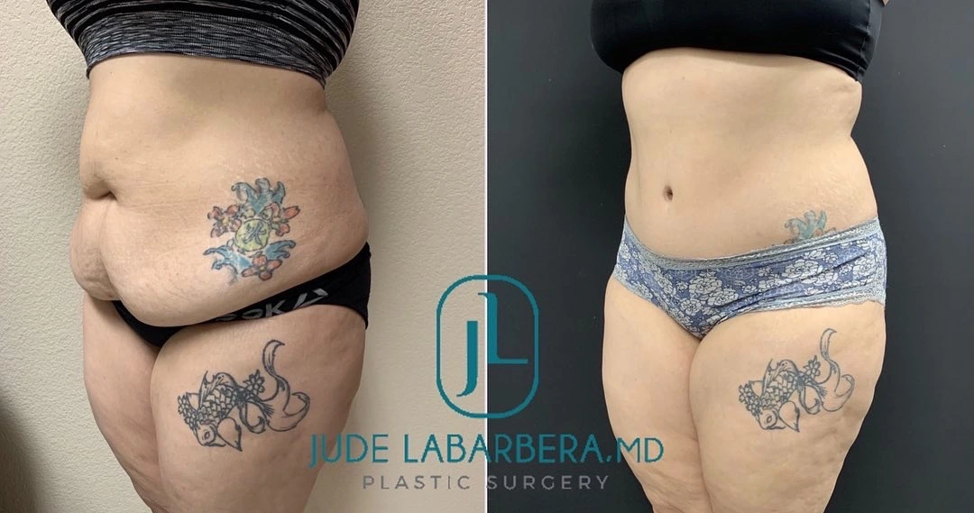 TUMMY TUCK Before & After Case Number 00087