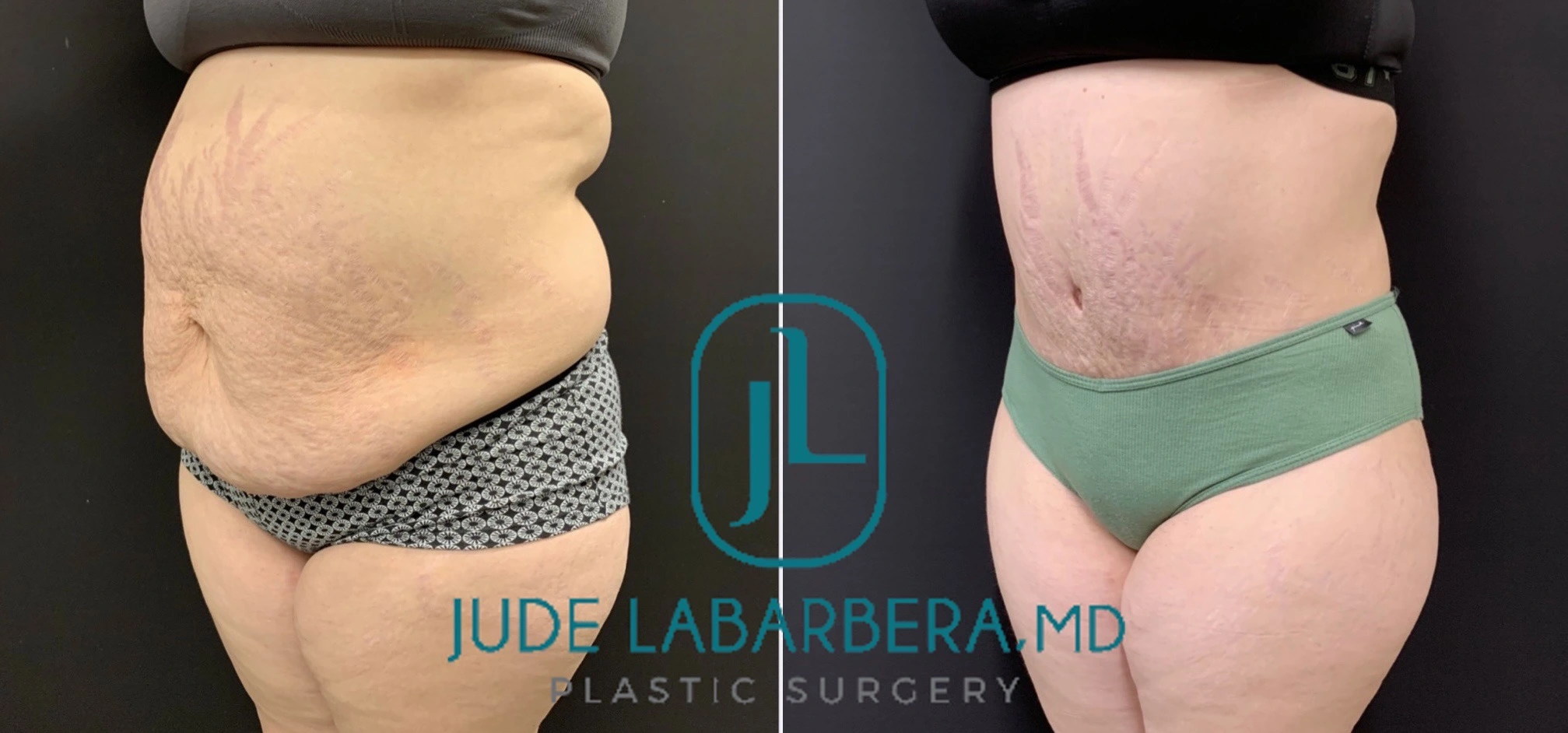 TUMMY TUCK Before & After Case Number 00088