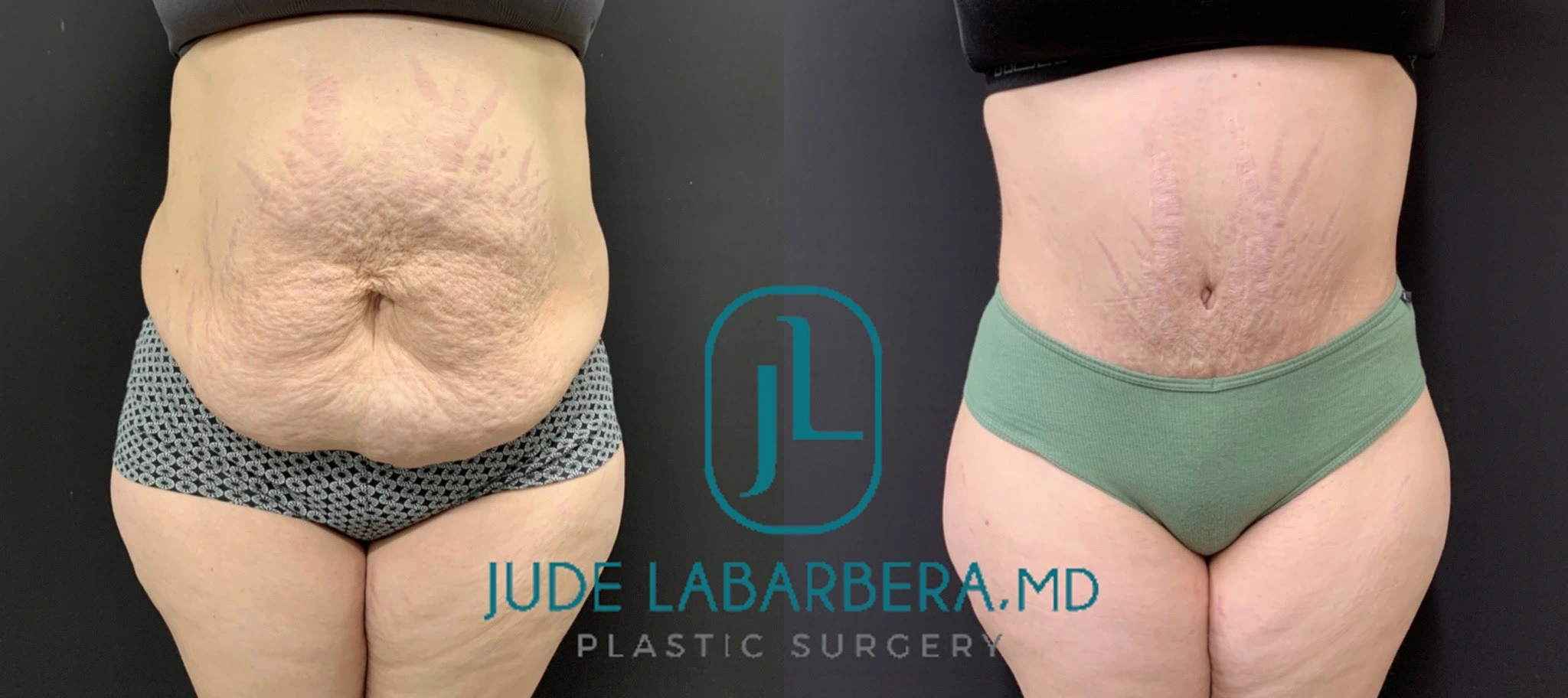TUMMY TUCK Before & After Case Number 00088
