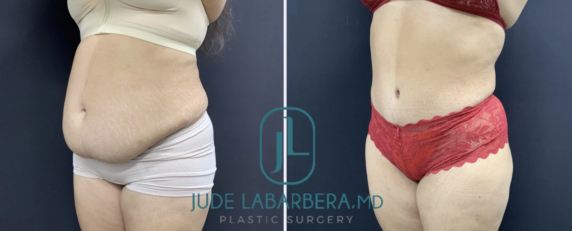 TUMMY TUCK Before & After Case Number 00092
