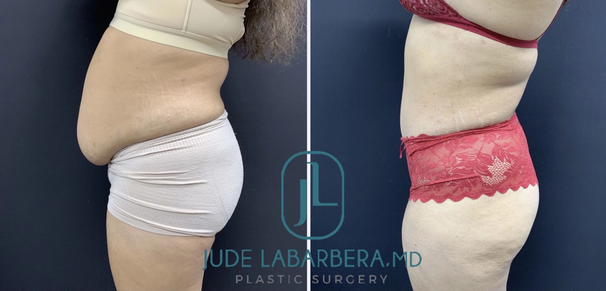 TUMMY TUCK Before & After Case Number 00092