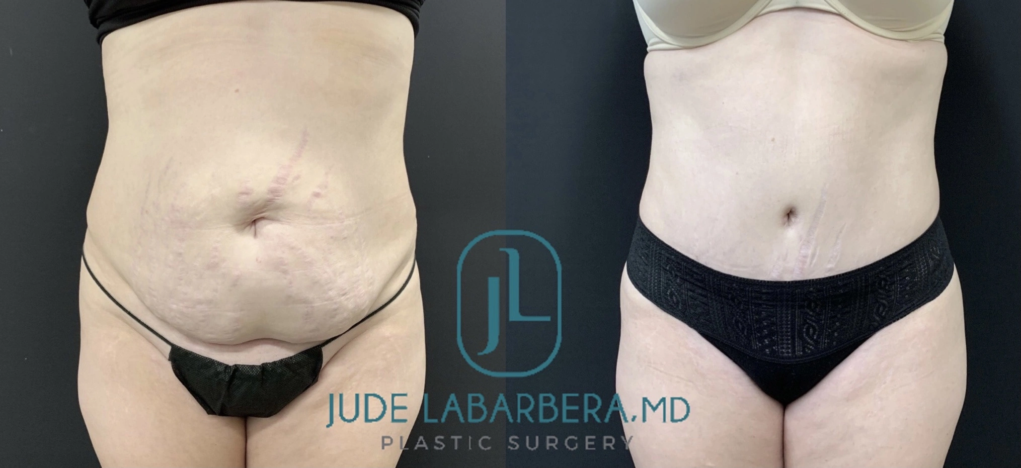 TUMMY TUCK Before & After Case Number 00093