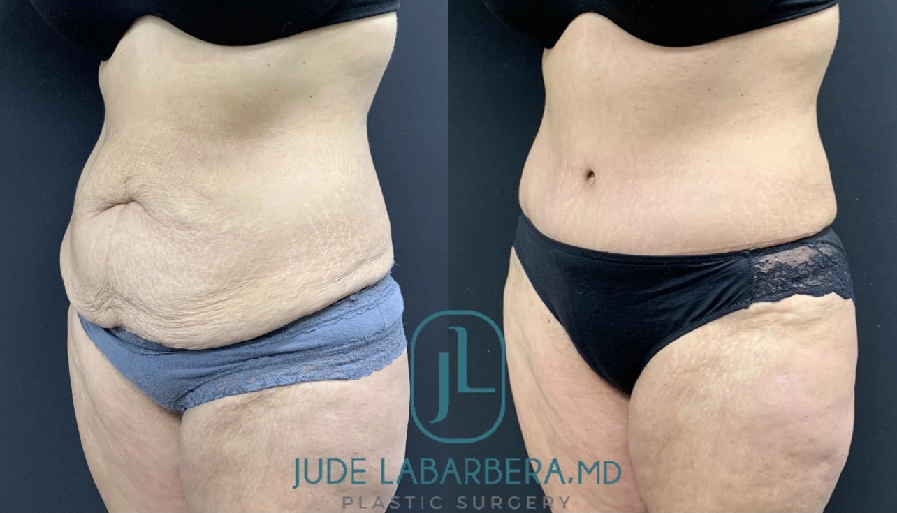 TUMMY TUCK Before & After Case Number 00095