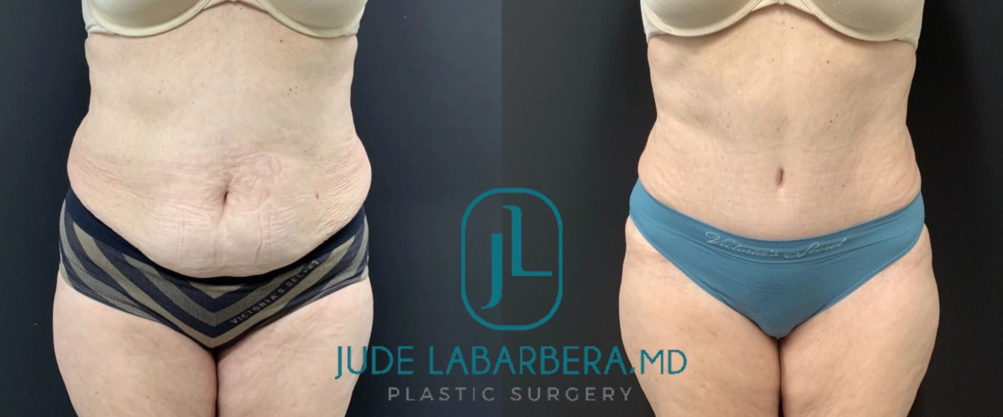 TUMMY TUCK Before & After Case Number 00097