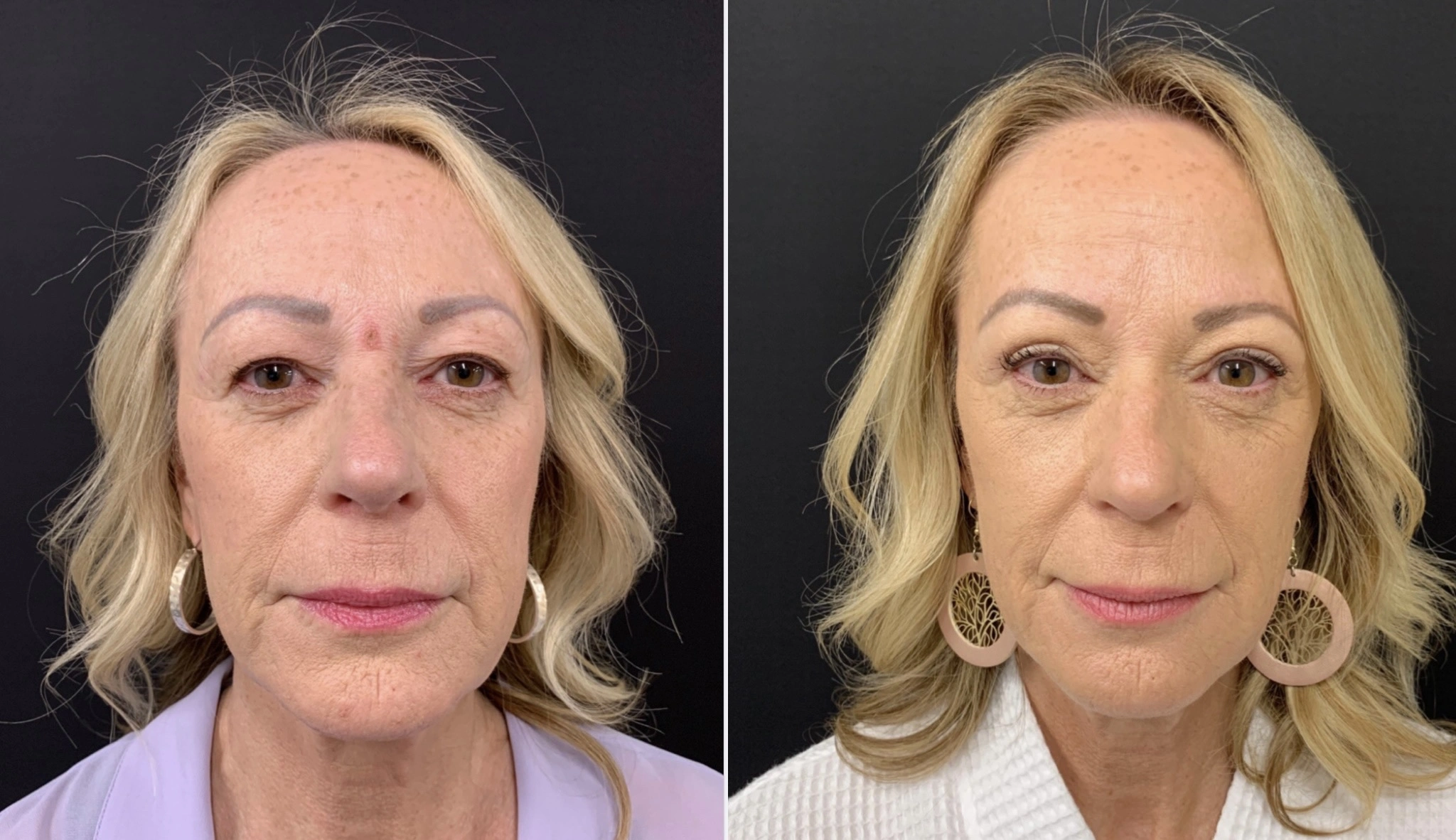 UPPER EYELID LIFT Before & After Case Number 0003