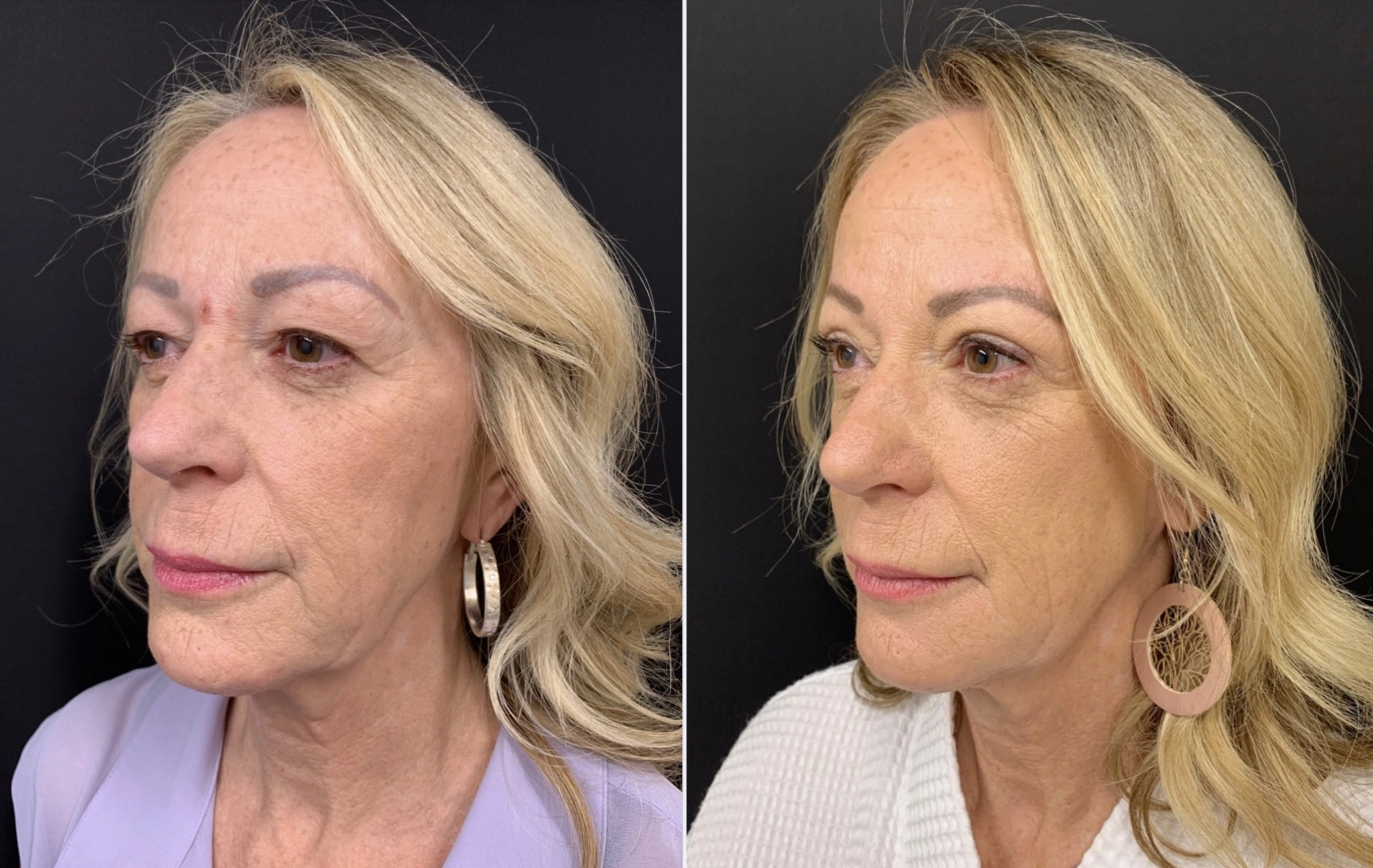 UPPER EYELID LIFT Before & After Case Number 0003