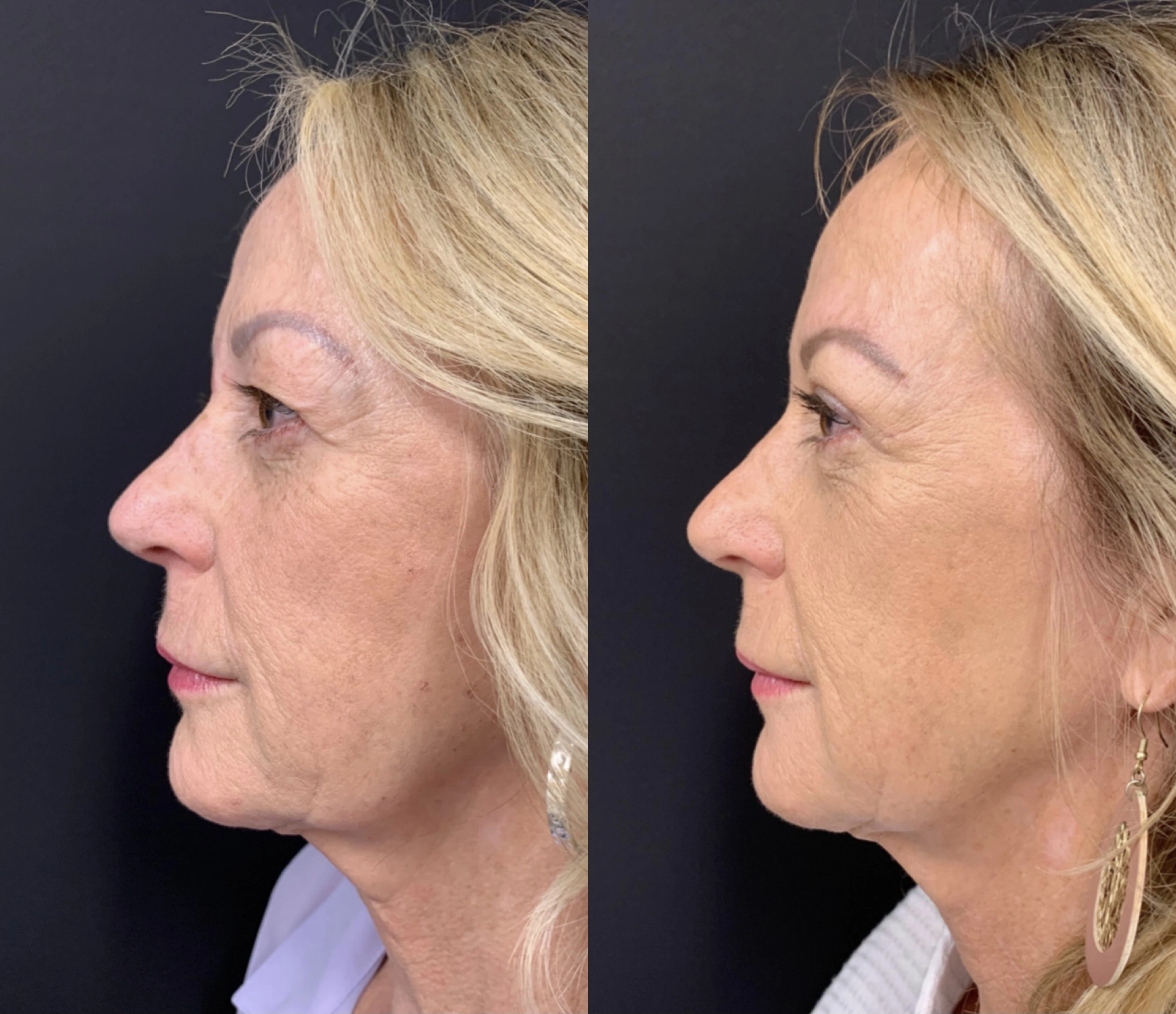 UPPER EYELID LIFT Before & After Case Number 0003