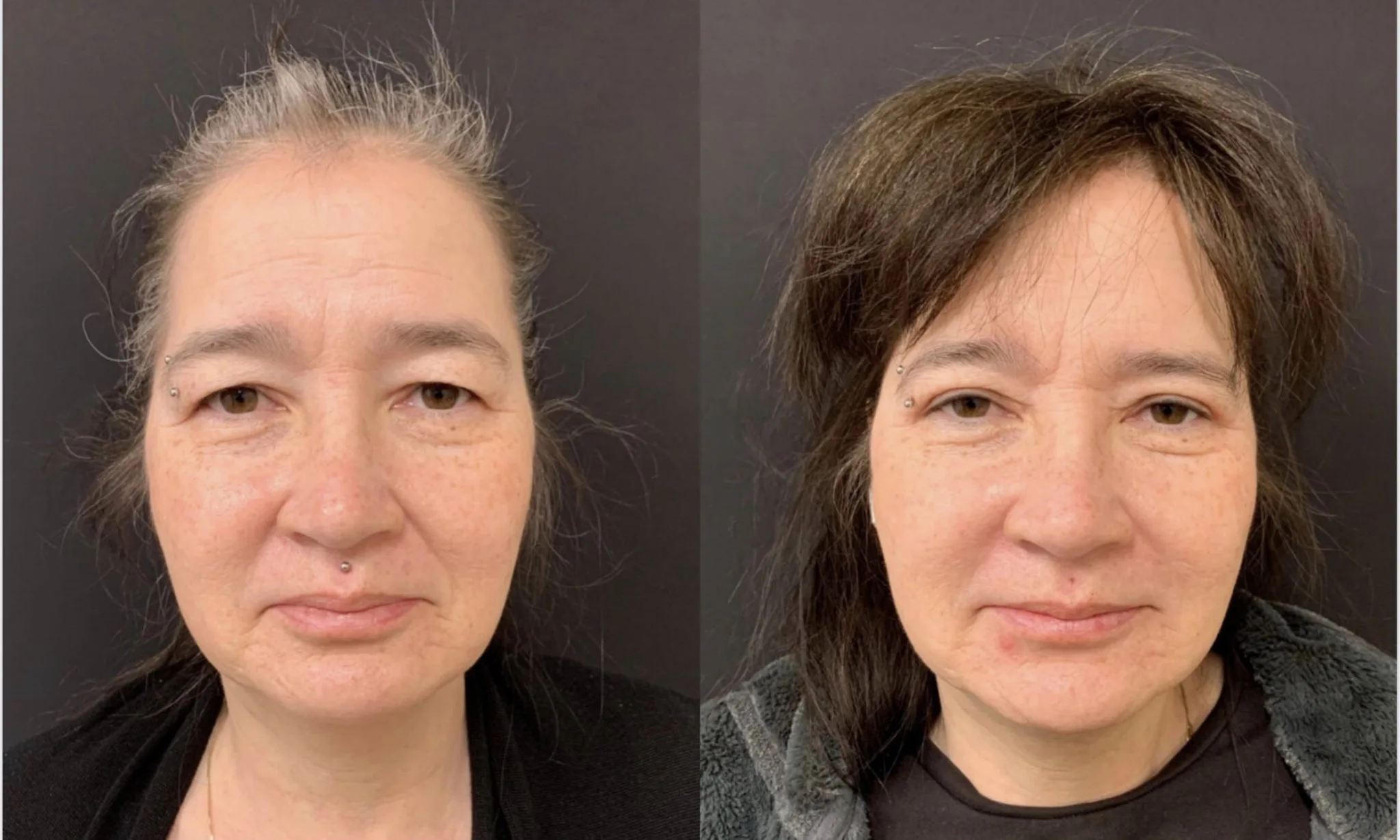 UPPER EYELID LIFT Before & After Case Number 0004