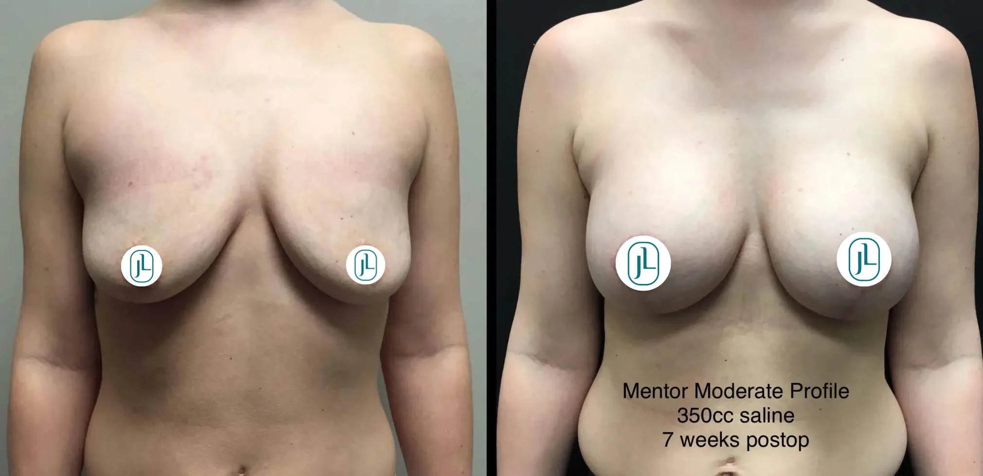 Breast Lift before & after banner