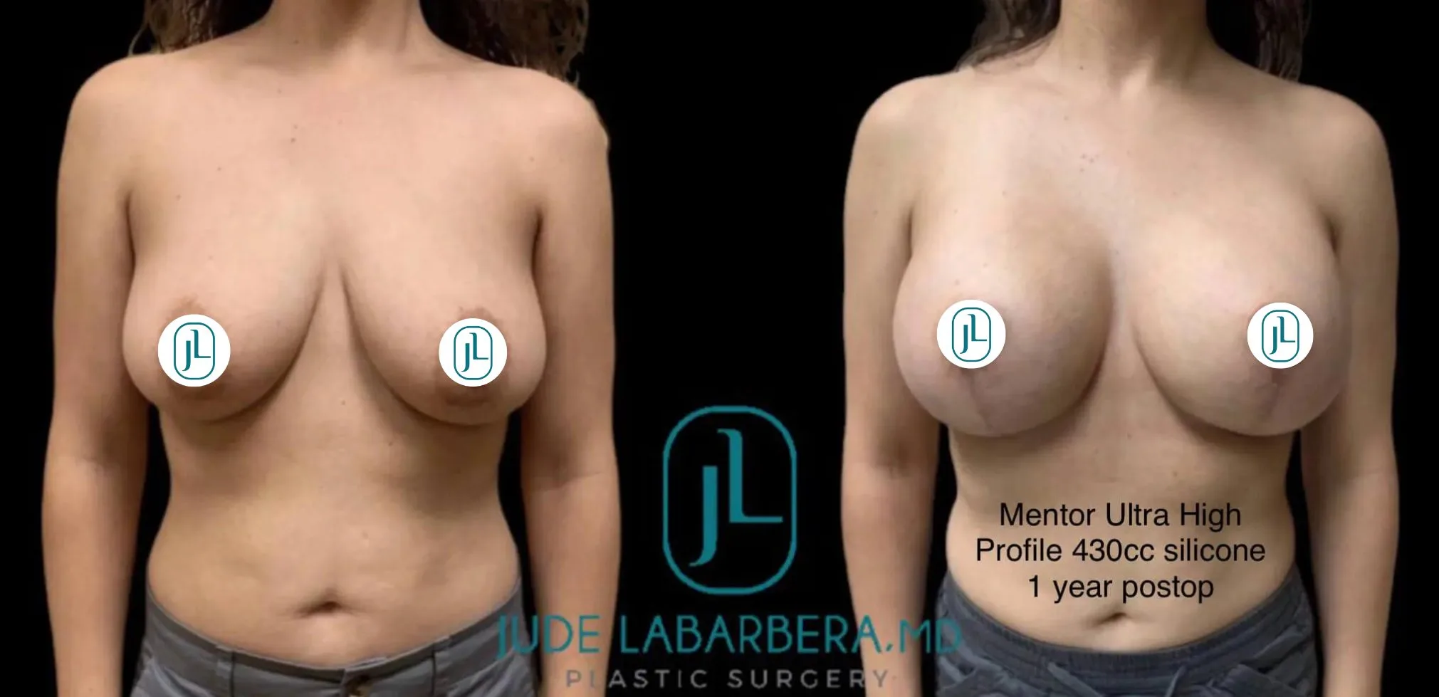 Breast Lift before & after