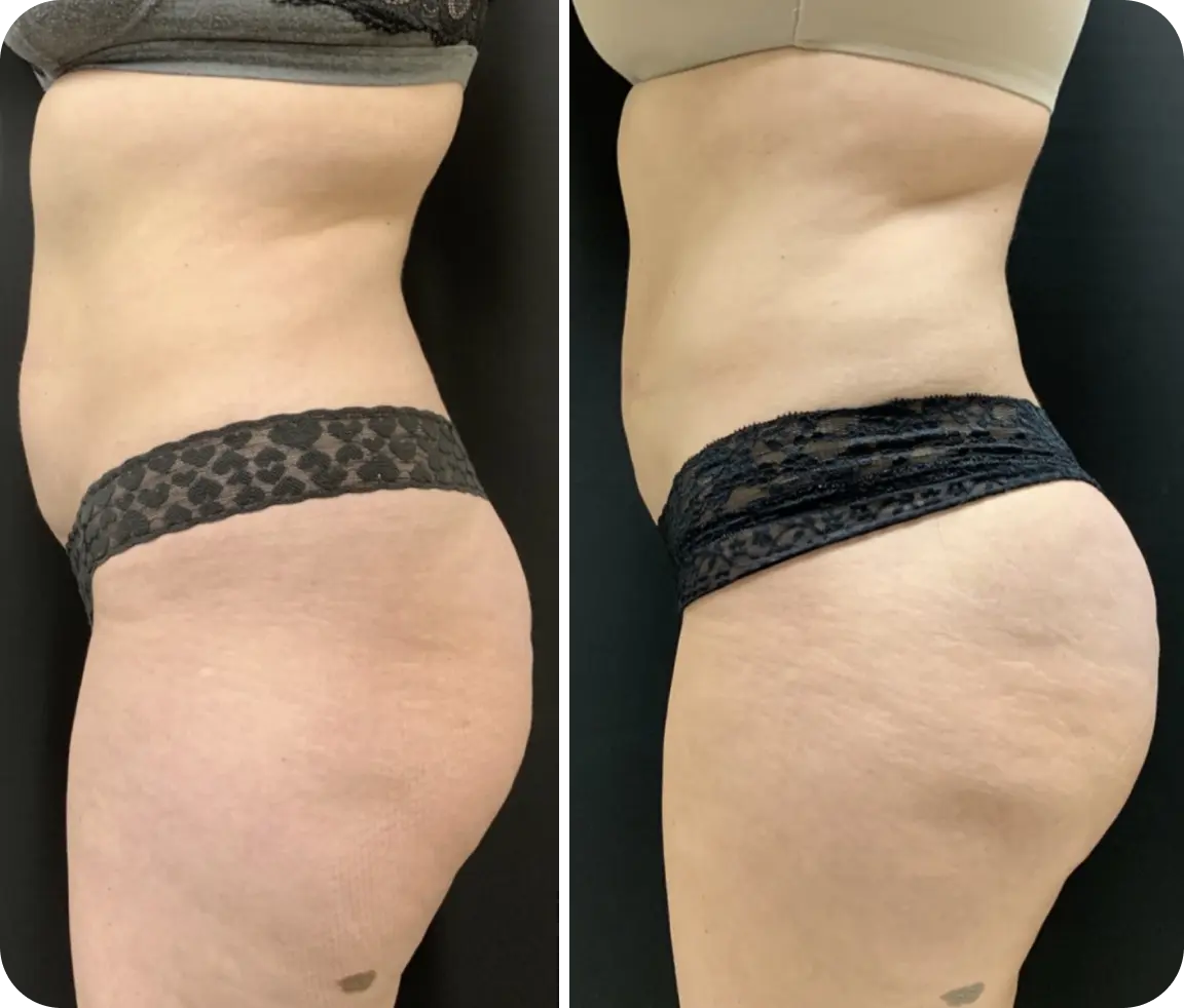 Brazilian Butt Lift Before & After Banner