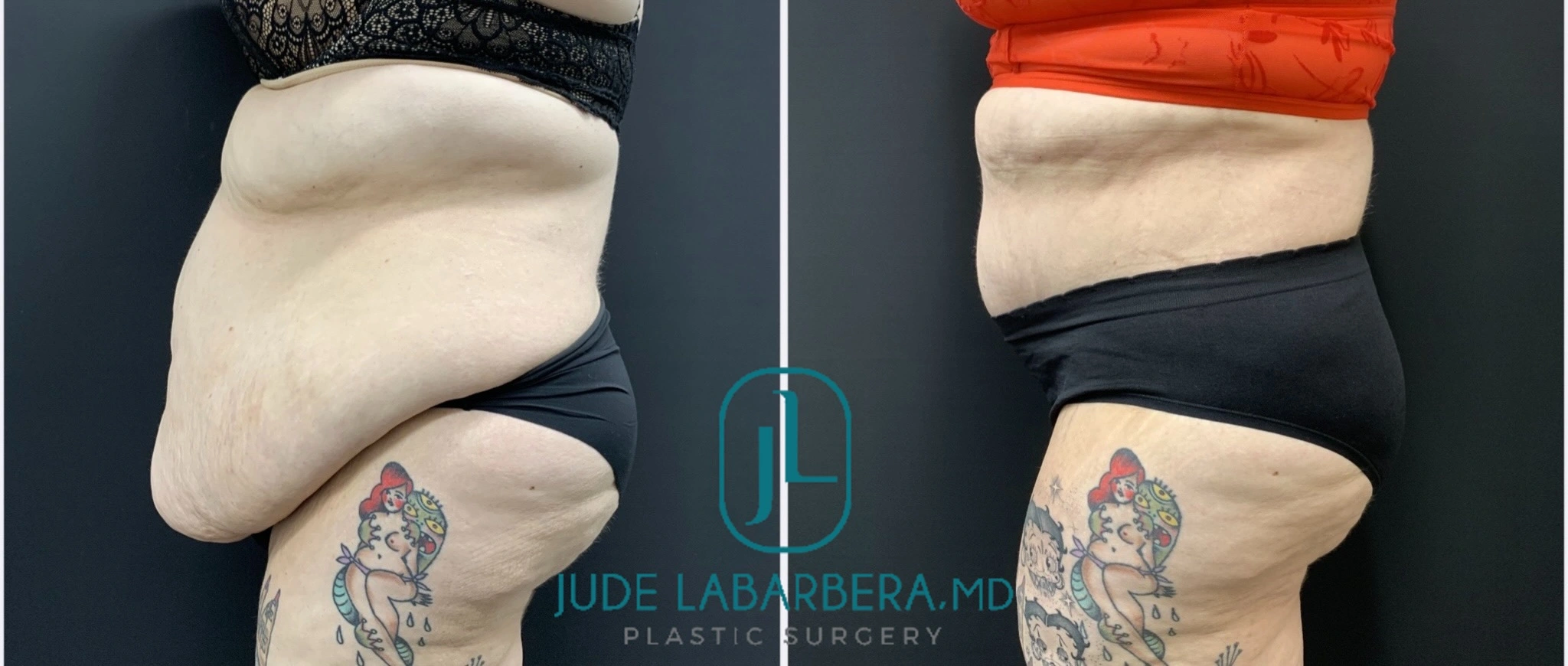 Fleur-de-Lis Tummy Tuck Procedure Banner