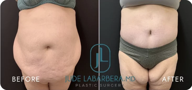 Before & After Gallery: Tummy Tuck Banner
