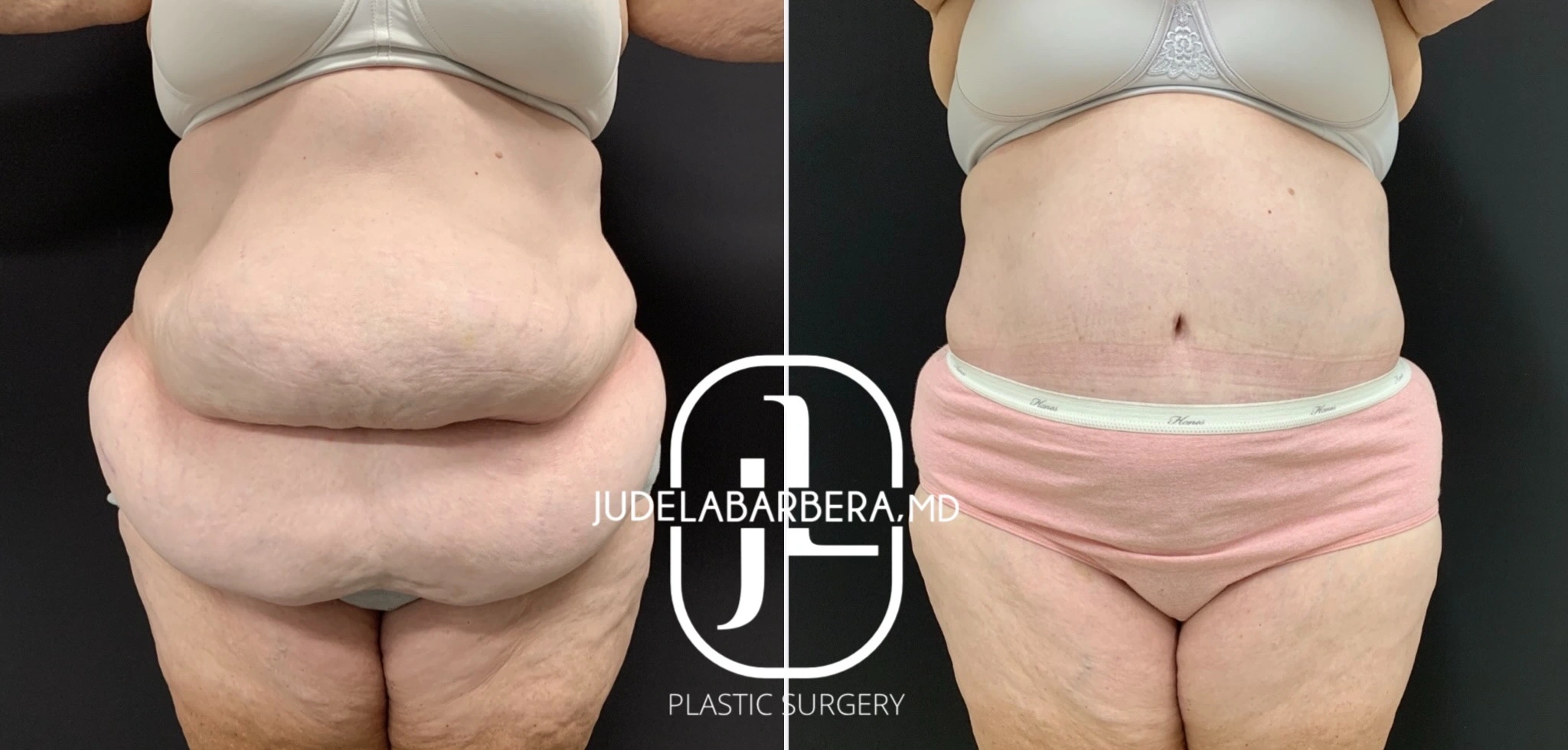 Before & after Tummy Tuck Procedure Banner
