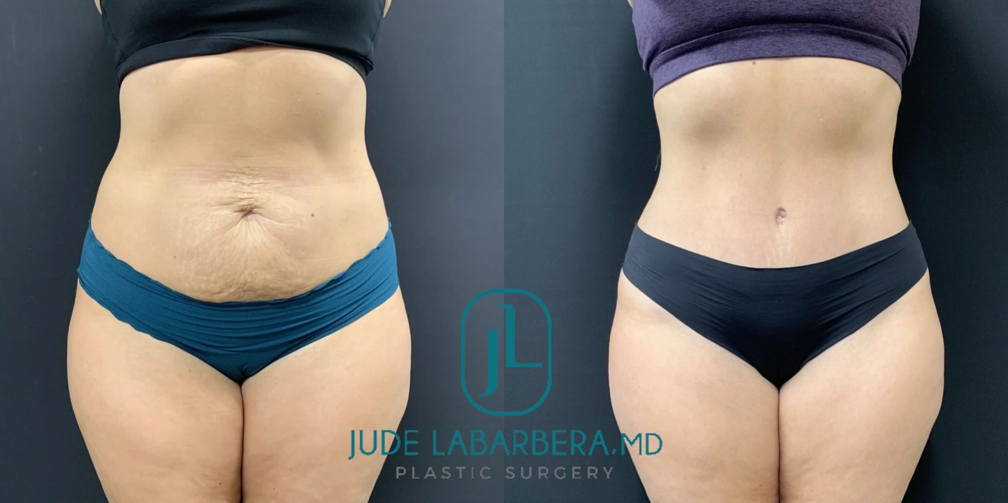 Before & after Banner