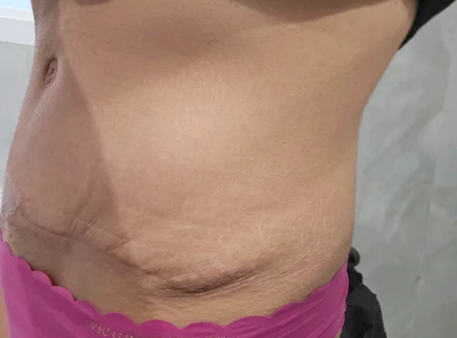 Dog Ears After Tummy Tuck Banner