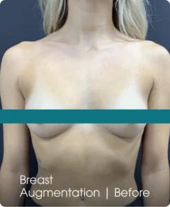 Breast Augmentation: Before Banner