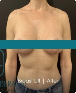 Breast Lift: After Banner