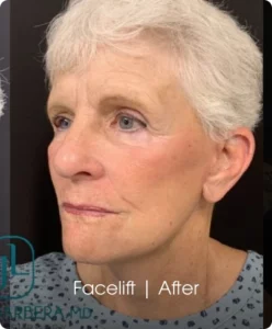 Facelift: After Banner