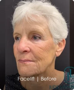 Facelift: Before Banner