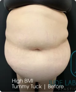High BMI Tummy Tuck: Before Banner